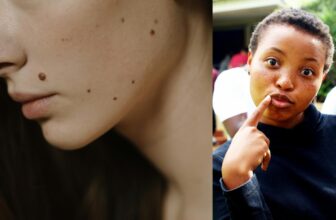 Freckles, Moles, and Birthmarks Explained Simply