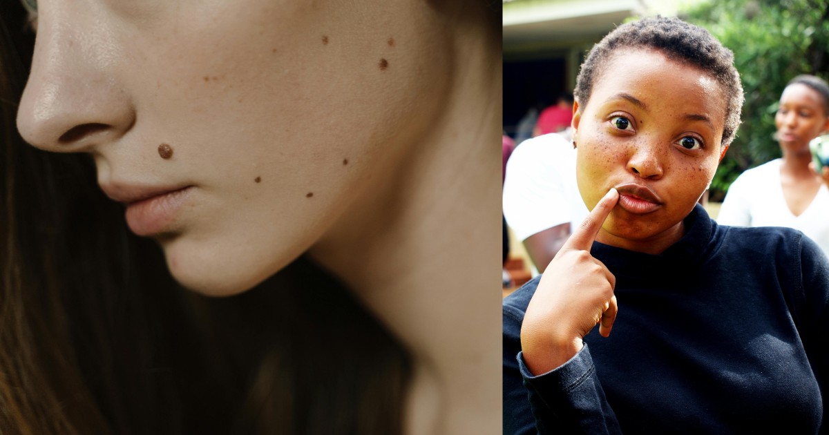 Freckles Moles And Birthmarks Explained Simply Fairness Kit