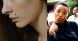 Freckles, Moles, and Birthmarks Explained Simply